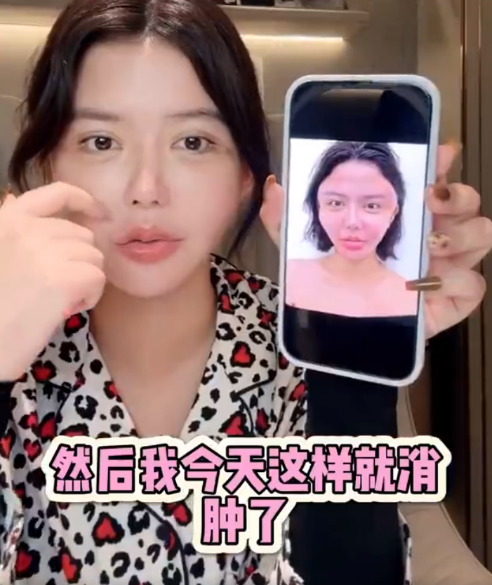 韩安冉产后一月就整容,大方晒出打针后的照片,整个脸都变形了(图6)