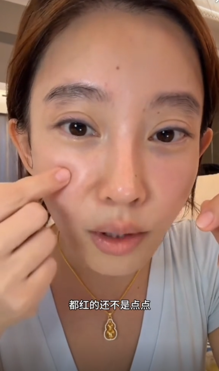 一毛钱的面膜敢用吗，我就敢！冯提莫讲述因捡便宜变成“激素脸”(图5)