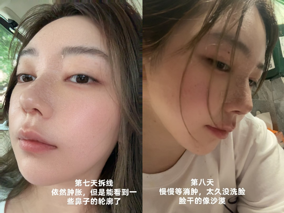 刘飞儿发文后悔整容？十年心结一朝解，坦言后悔没早去做鼻子(图4)